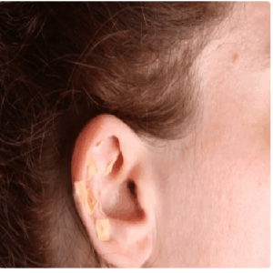 Auriculoterapia